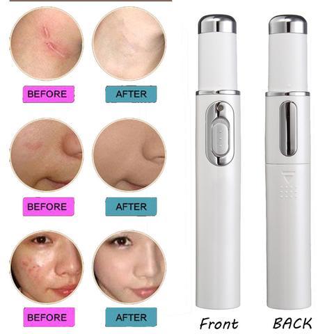 Wrinkle and Scar Removal Skincare Tool – White Acne Pen
